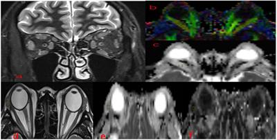 Diffusion Tensor Imaging Technology to Quantitatively Assess Abnormal Changes in Patients With Thyroid-Associated Ophthalmopathy